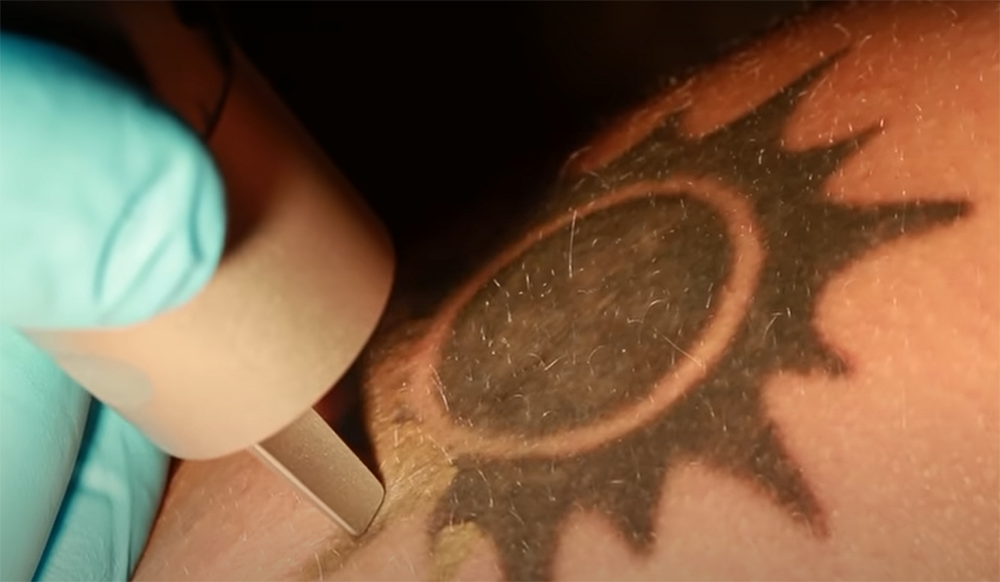 Who is a Tattoo Removalist and What Are Their Responsibilities?