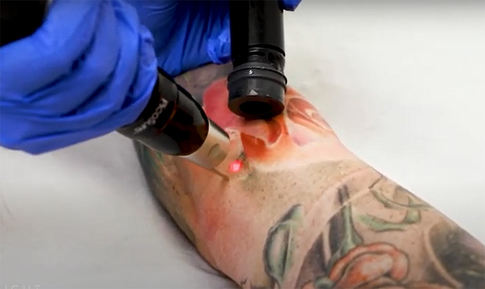 Who Can Become a Tattoo Removalist?