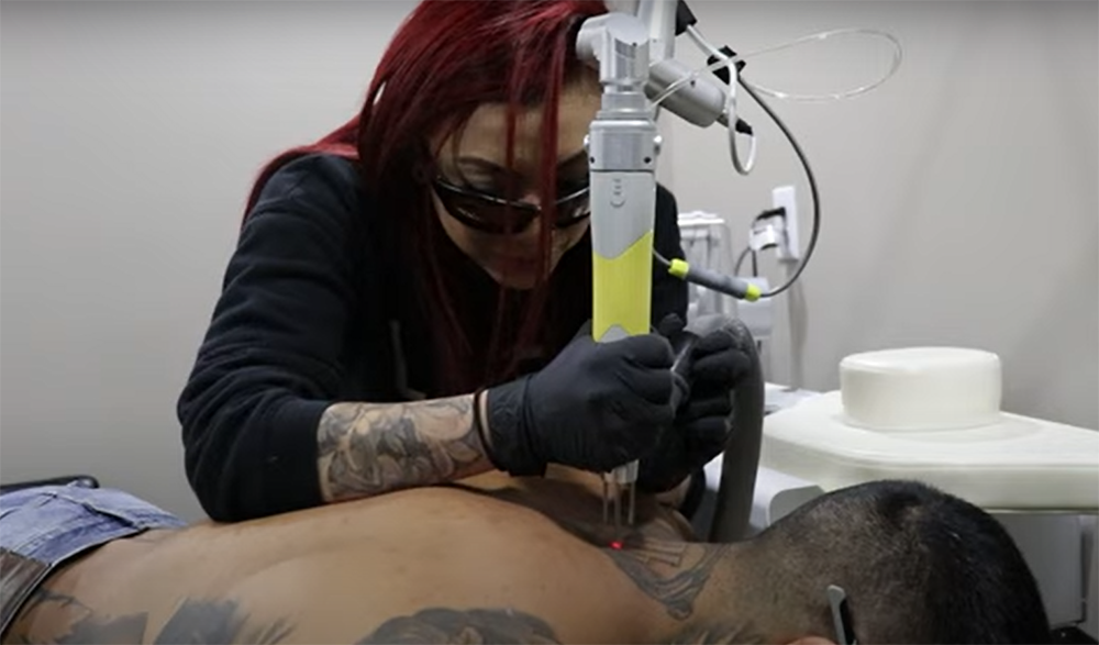How to Become a Tattoo Removalist