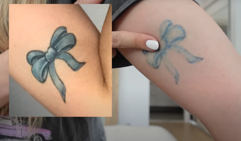 Can black tattoos be fully removed?
