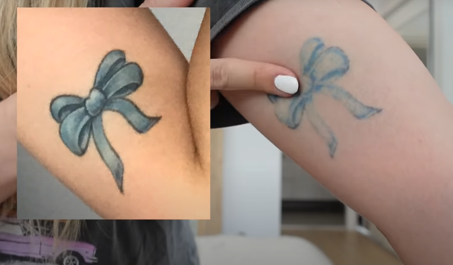 Can You Tattoo Over a Removed Tattoo? TattooProfy