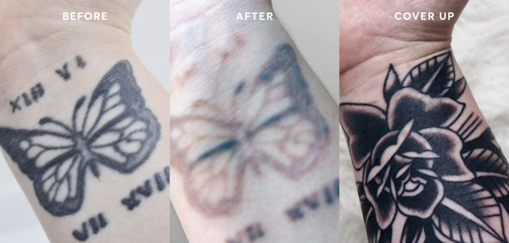 What are the side effects of laser tattoo removal?