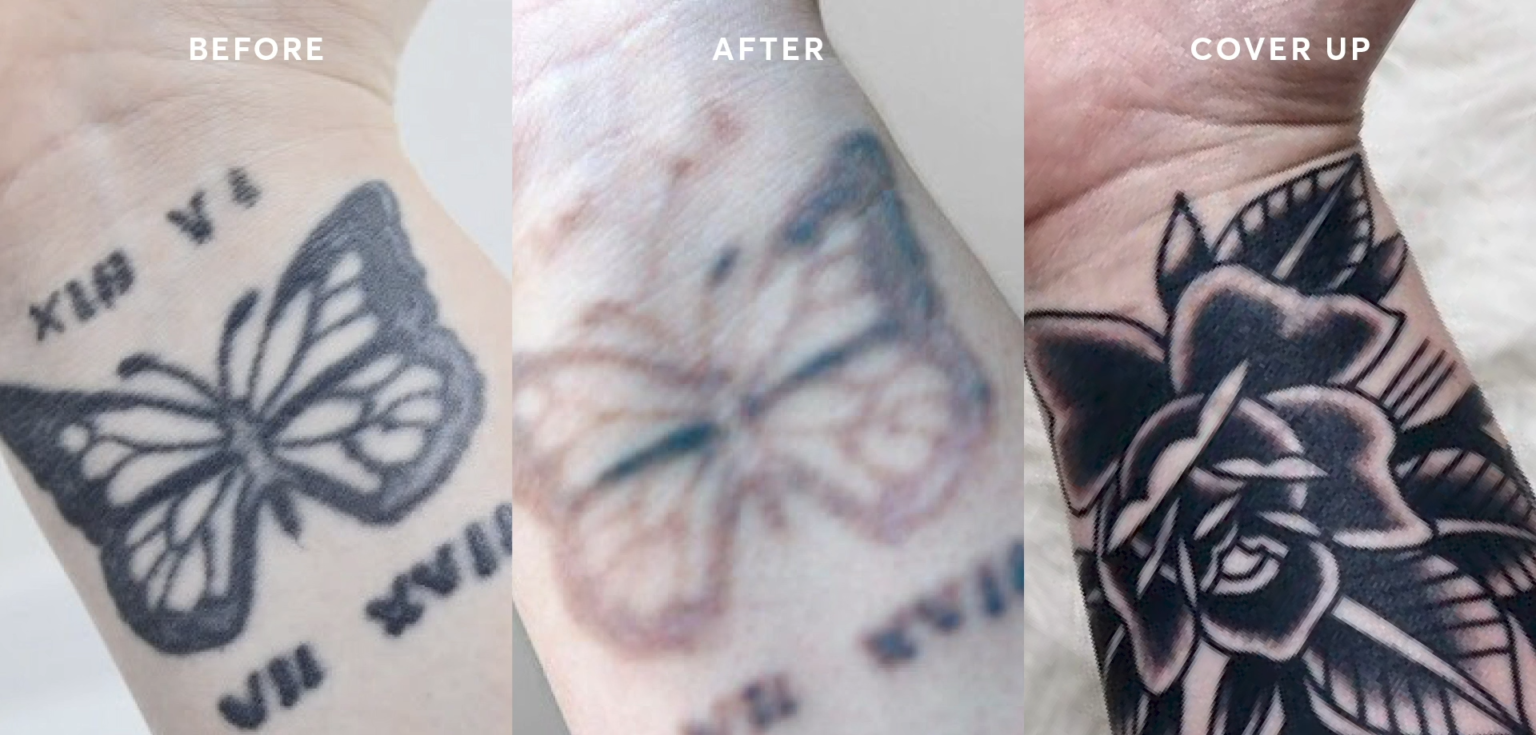 Can You Tattoo Over a Removed Tattoo? TattooProfy