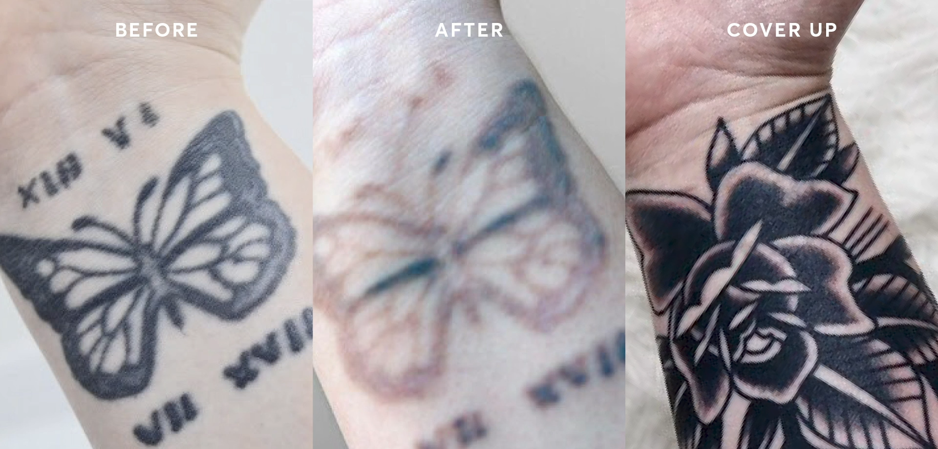 Can You Tattoo Over A Removed Tattoo Tattooprofy