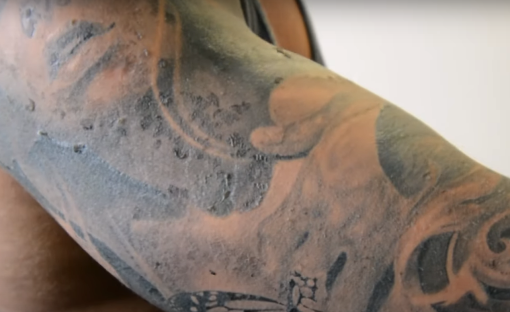 What Is Tattoo Peeling?