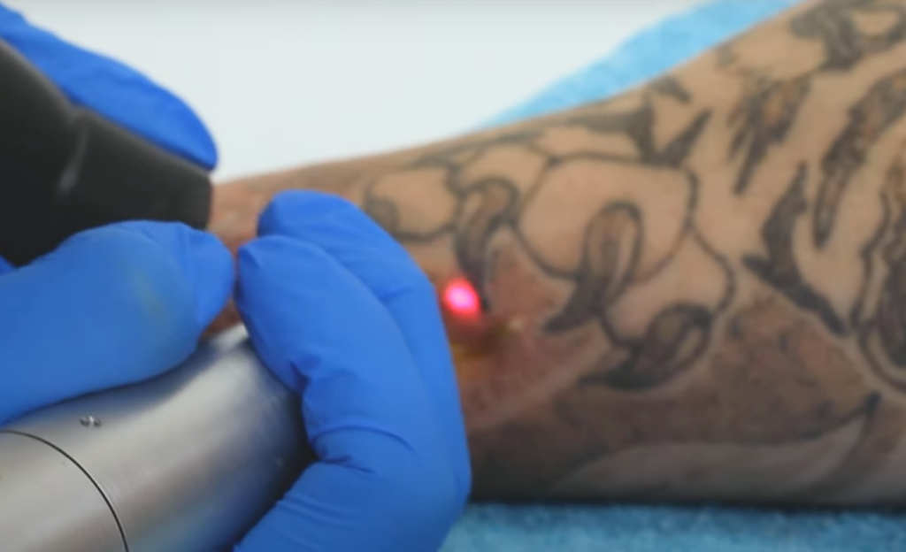 How Does Laser Removal Work?