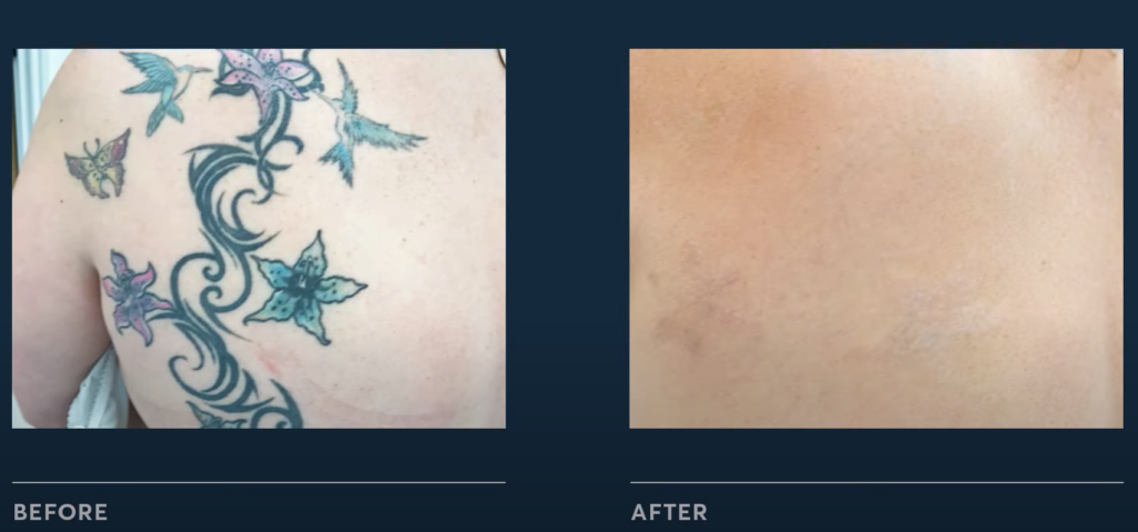The Benefits of Laser Tattoo Removal