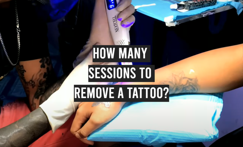 How Many Sessions to Remove a Tattoo? TattooProfy