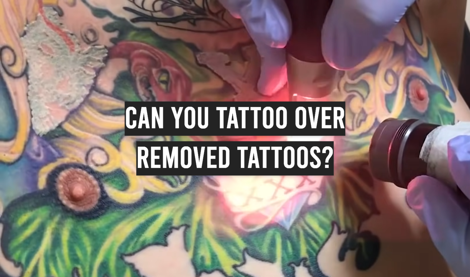 Can You Tattoo Over Removed Tattoos?