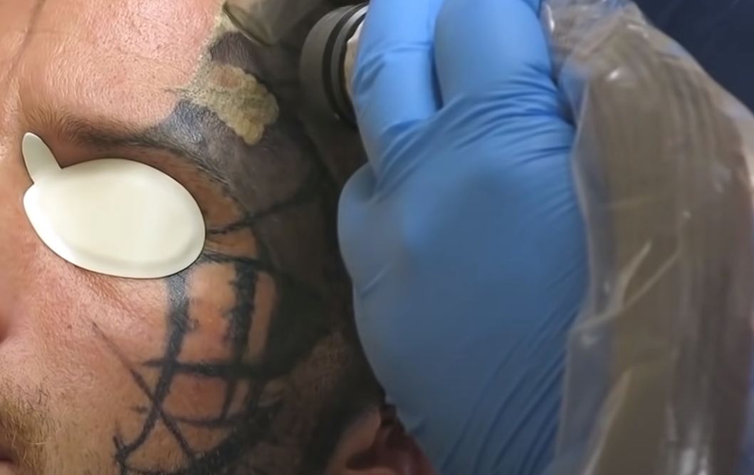 What Factors Should You Consider Before Getting a New Tattoo After Removal of the Old One?