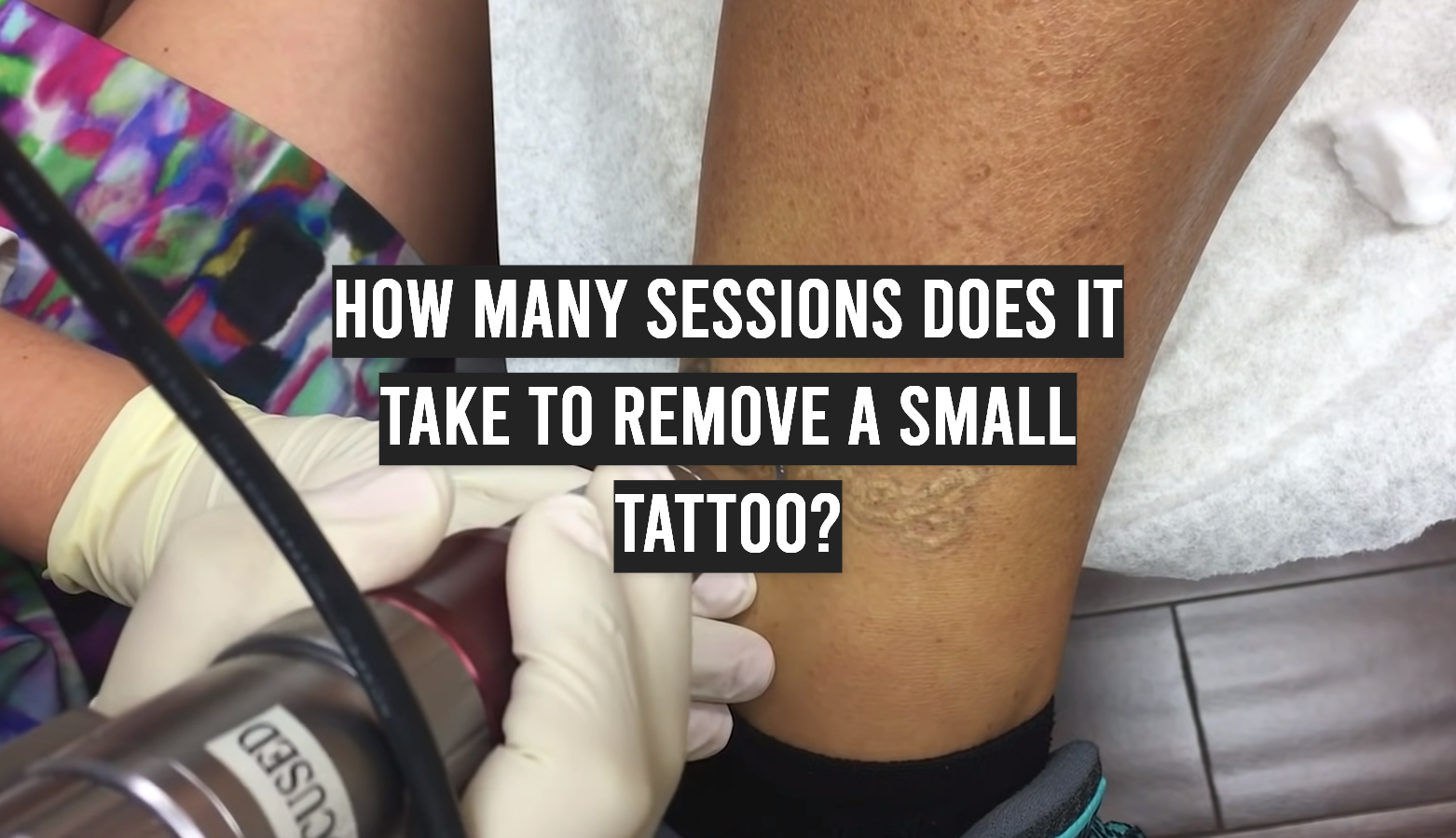 How Many Sessions Does It Take To Remove a Small Tattoo?